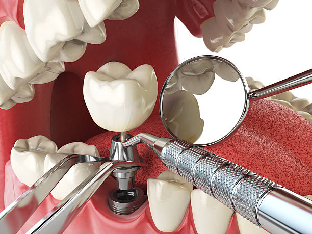 Best Emergency Denture Repair in Baker, LA